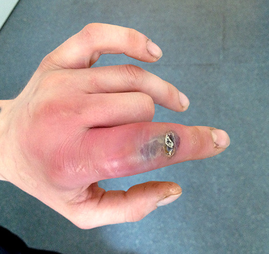 Das Bild zeigt die Auswirkung der Phlegmone am Zeigefinger eines Patienten 
(nicht der Schreiber des Leserbriefs) (Bild: Doccheck)